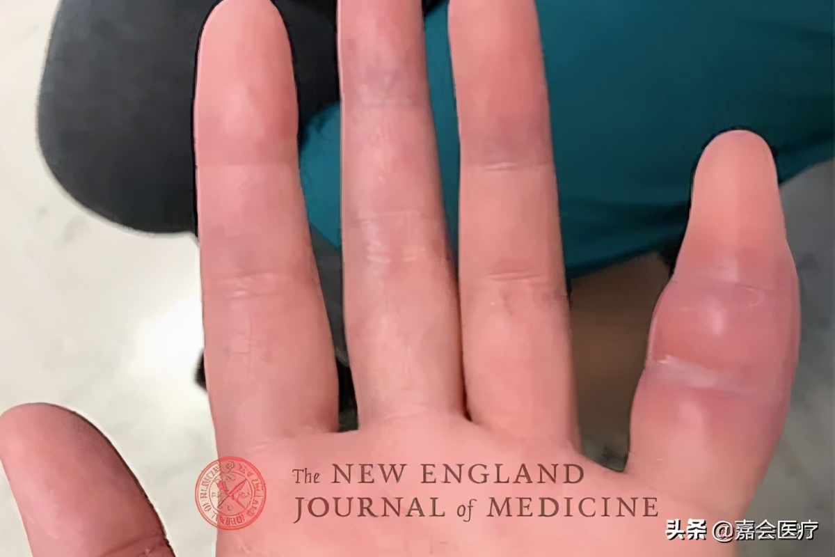 妻子左手小指头肿胀，竟是丈夫外出旅行导致的？