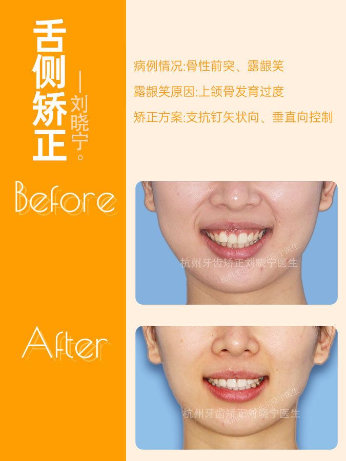 杭州牙齿矫正丨露龈笑怎么办？全面告别露龈笑的4大方法