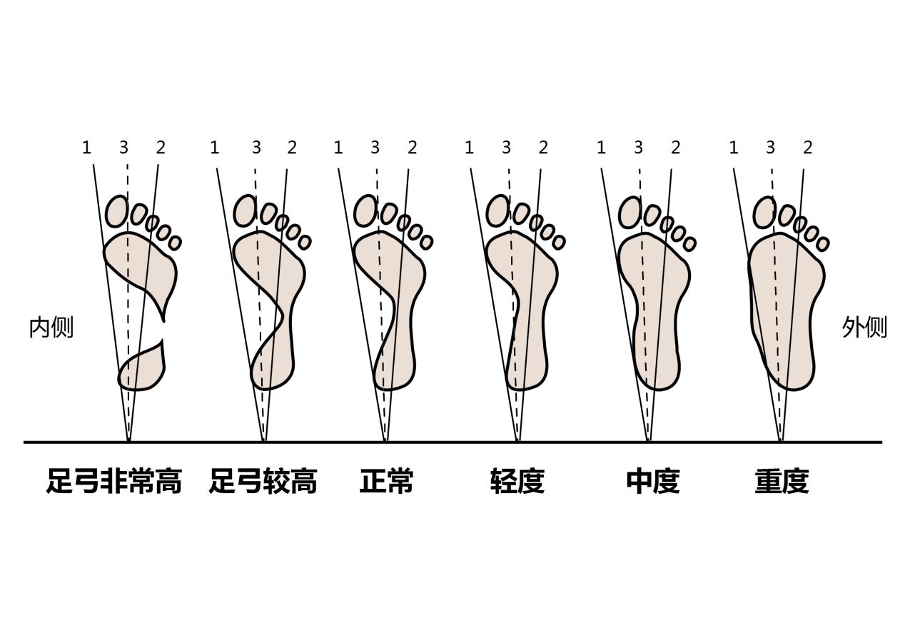足弓高会导致脚后跟疼吗如何治疗,脚后跟疼是因为足弓高还是足弓低