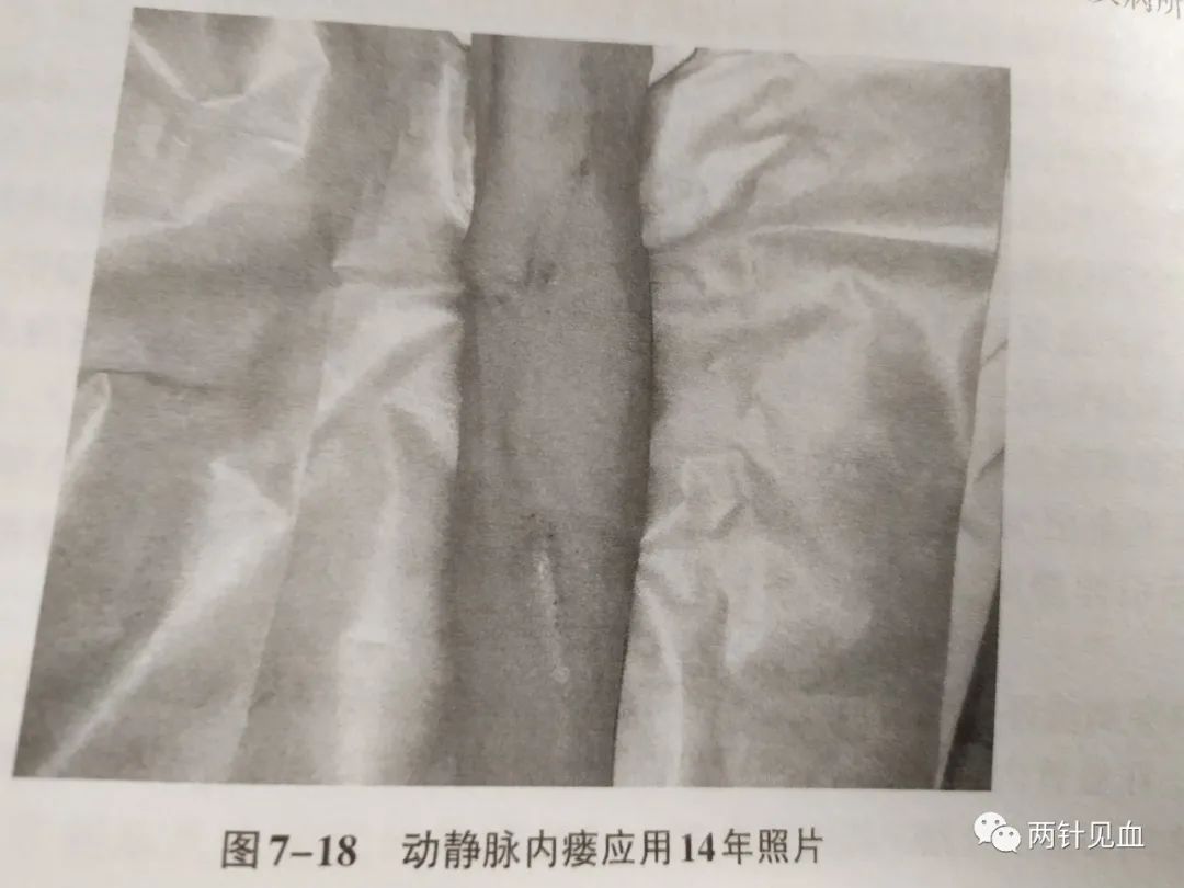 血透内瘘穿刺方式有几种方法,血透静脉内瘘在哪里做