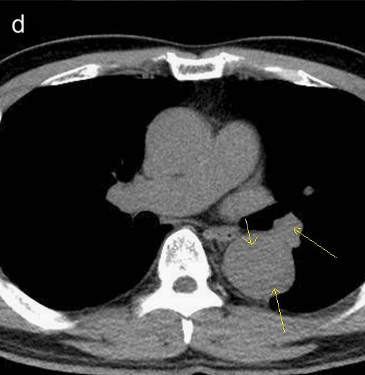 胸部Ct平扫能查出主动脉夹层吗,主动脉夹层cta影像图片解读