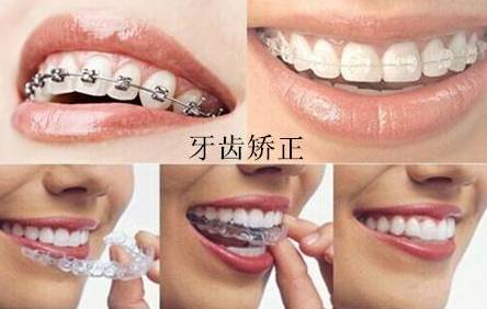 牙齿矫正方案动态图在哪里查看,牙齿矫正前后对比动态图