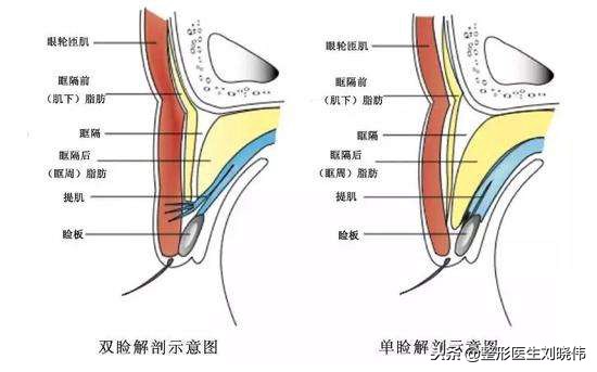 眼睛手术的坑，不要往里面跳了