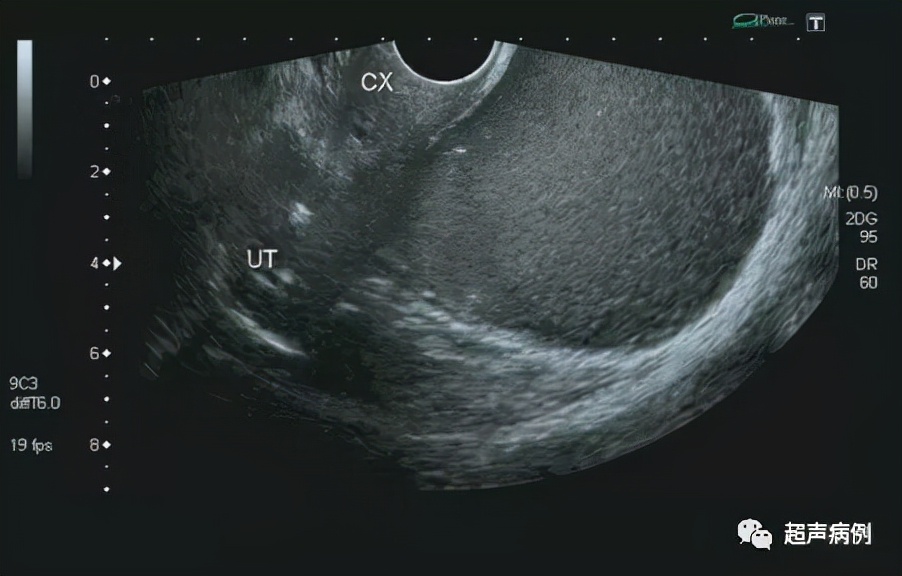 臀部疼痛就诊，超声意外发现这样盆腔包块
