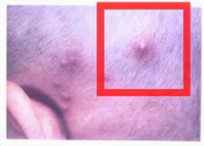 天热没空调婴儿怎么预防热痱子,宝宝热出痱子还不能吹空调吗