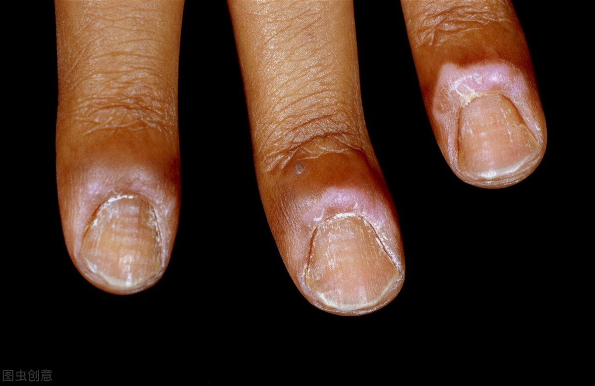 脚趾甲沟炎特别疼怎么办,脚趾甲甲沟炎疼怎么处理