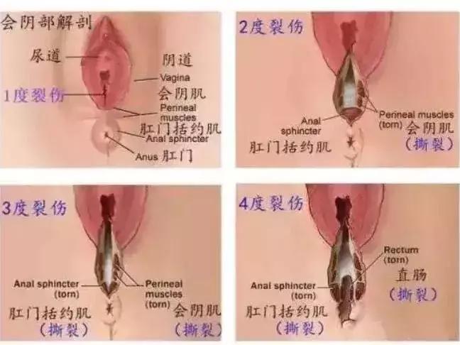 顺产时，自然撕裂、侧切哪个恢复快？有什么区别和影响？