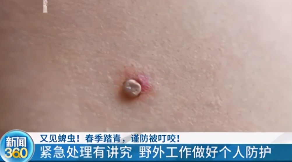 十大毒虫咬了会有什么症状,被各种毒虫咬伤容易得什么病吗