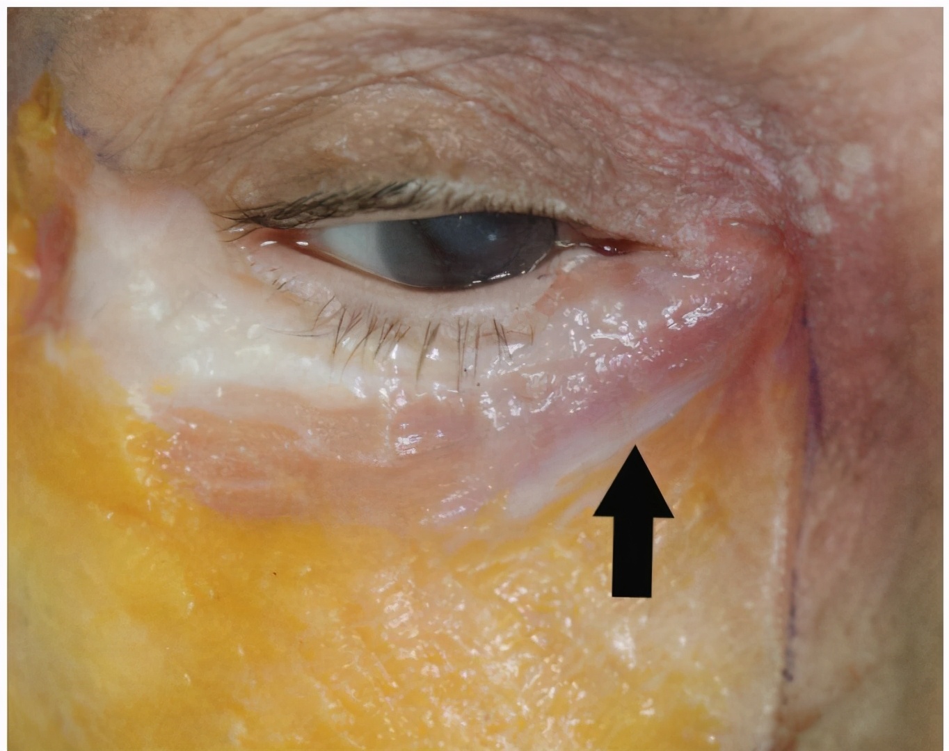 牙膏跟盐水能去眼袋吗,牙膏涂抹能祛眼袋