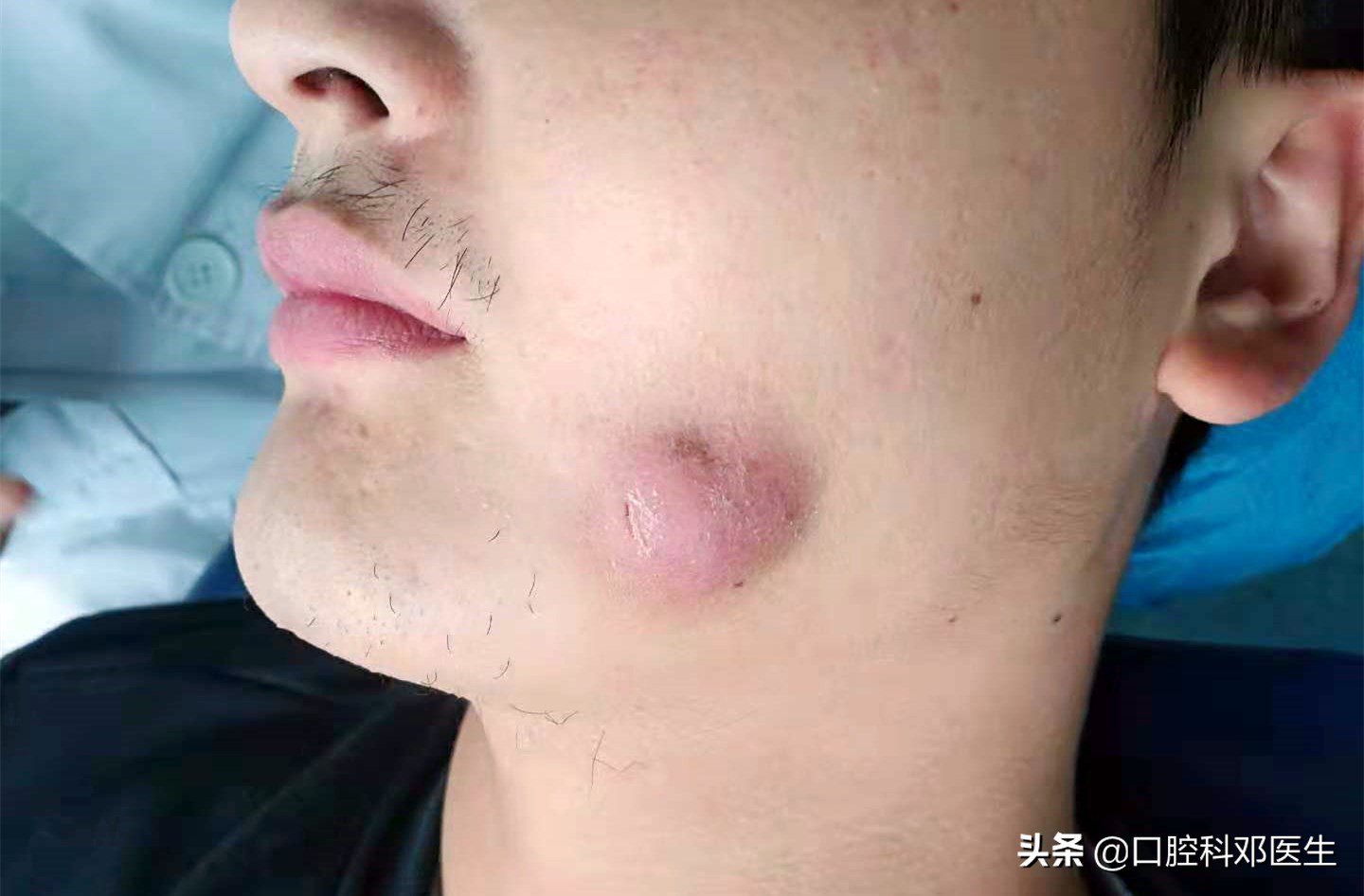 别让一颗牙齿毁了一张脸？医生说95%的人都有这样的牙齿！