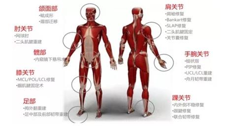 骨科植入锚钉,骨科手术锚钉