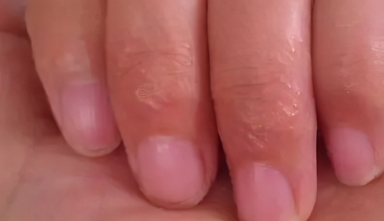 手干手脱皮有什么好办法吗,手脱皮是因为上火吗