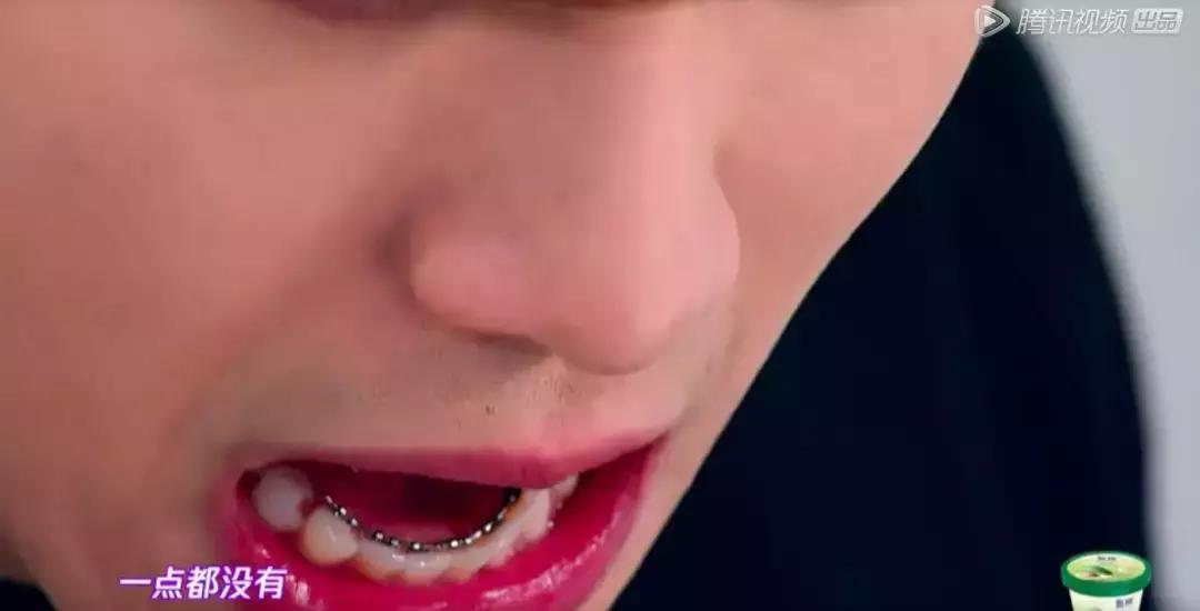 找了3个大学妹子聊聊：为什么在最美好的年纪戴牙套