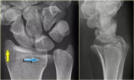 所有骨折都叫什么名字,骨折的名称有哪些