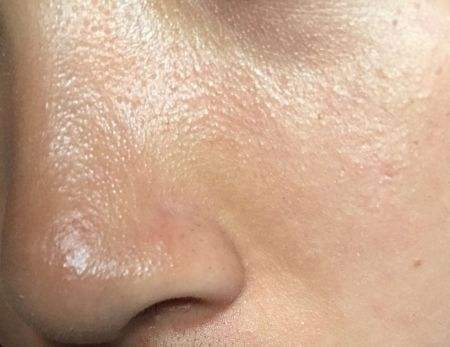 湿热长痘出油怎么调理,湿热出油长痘吃啥药