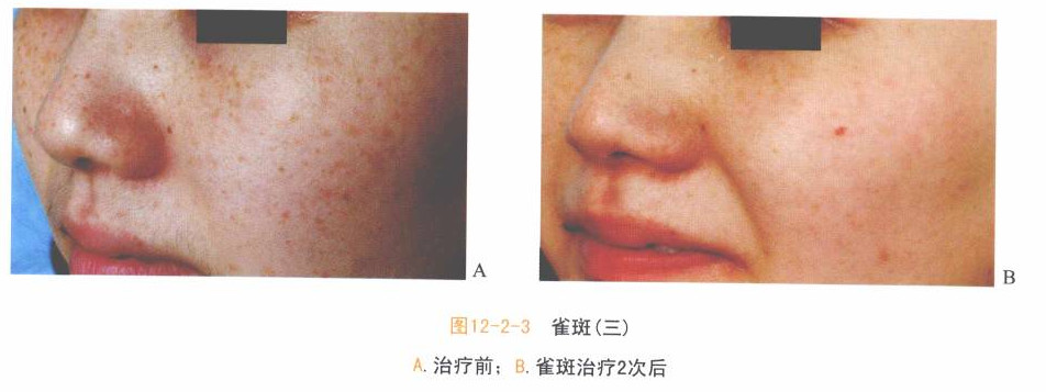 睡眠不好可以做光子嫩肤,前一天晒太阳了还能做光子嫩肤吗