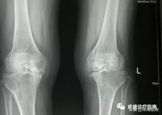 骨性关节炎诊疗方案及流程,骨性关节炎的护理诊断