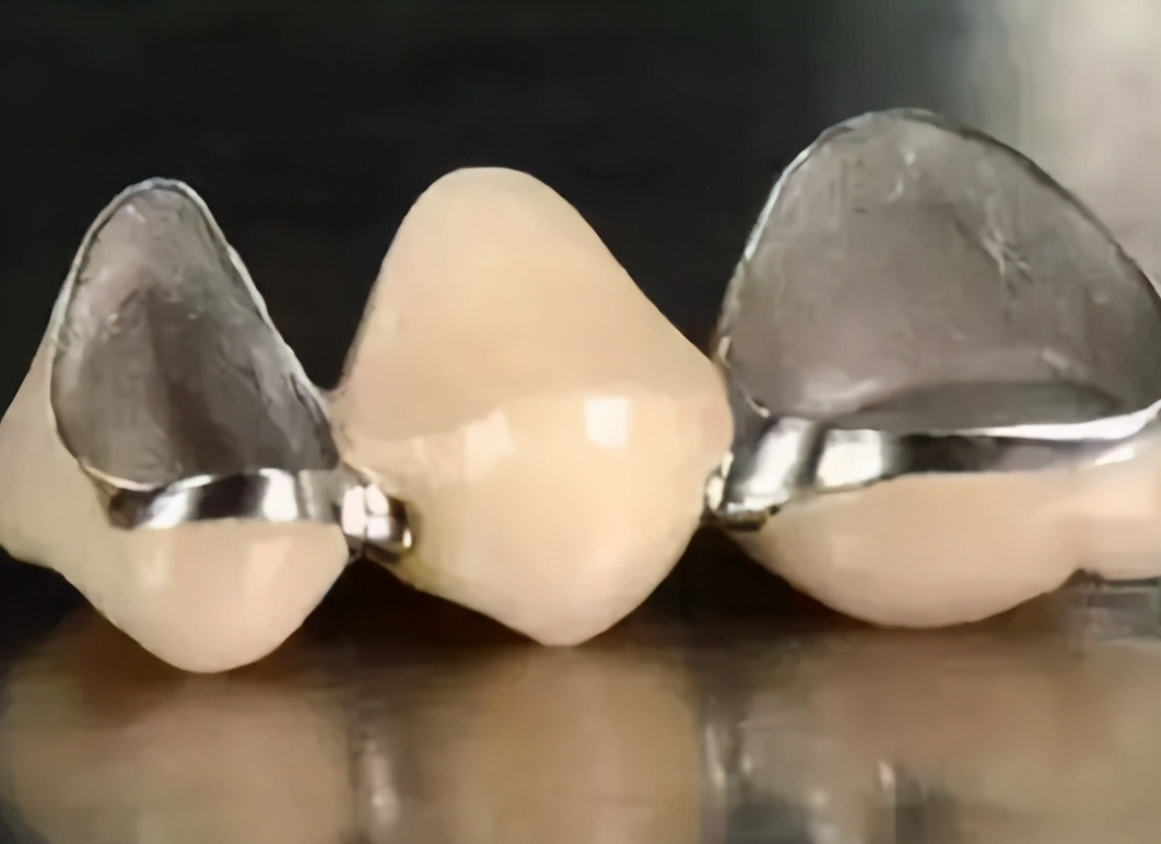 全瓷牙比烤瓷牙小,全瓷牙要比烤瓷牙磨牙多吗