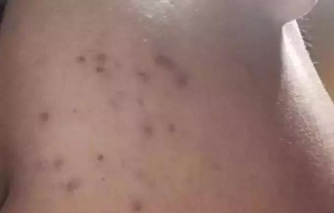 痘印反反复复怎么办,痘印一直反反复复怎么办