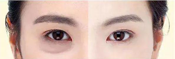 眼袋和卧蚕区别,卧蚕和眼袋的区别图片搞笑