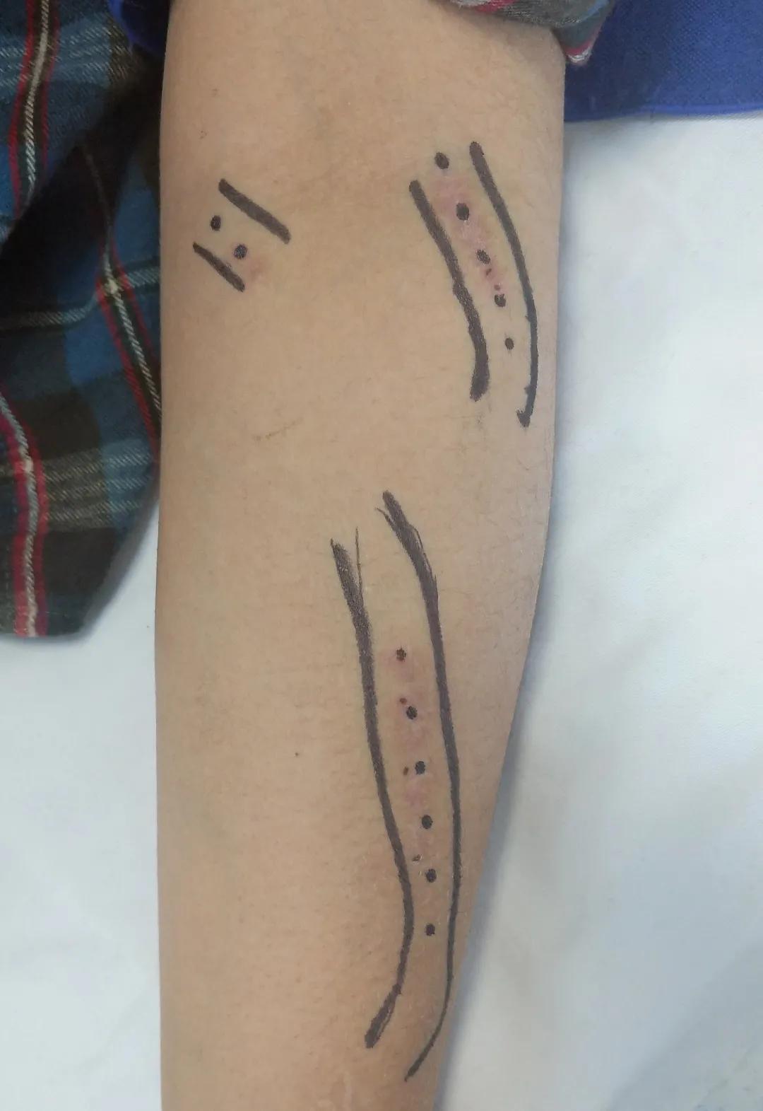 门医科普|透析病人动静脉瘘的日常护理