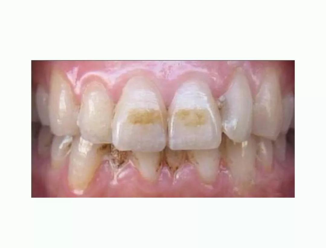 为什么每天刷两次牙还是黄,为什么刷过牙牙还是有点黄