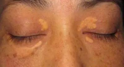 眼周长了黄疙瘩怎么办,眼周长疙瘩是怎么回事