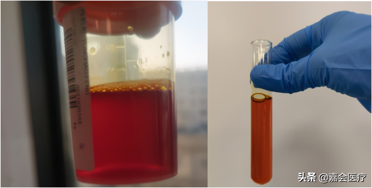 尿液突然变红、变绿？注意这些常见药会改变尿液颜色
