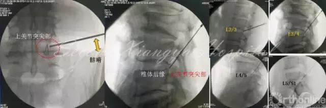 经皮腰椎间盘切除术有何优缺点,什么是经皮内镜腰椎手术