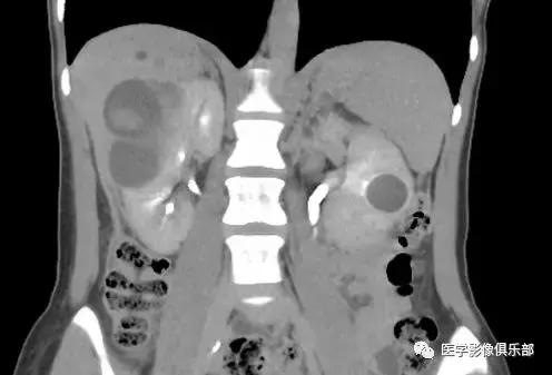 双肾多发小囊肿到底是不是多囊肾,肾多发囊肿与多囊肾的超声鉴别
