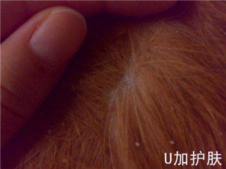 头皮干燥屑多是什么原因,洗头后头皮干燥头皮屑多掉屑很痒