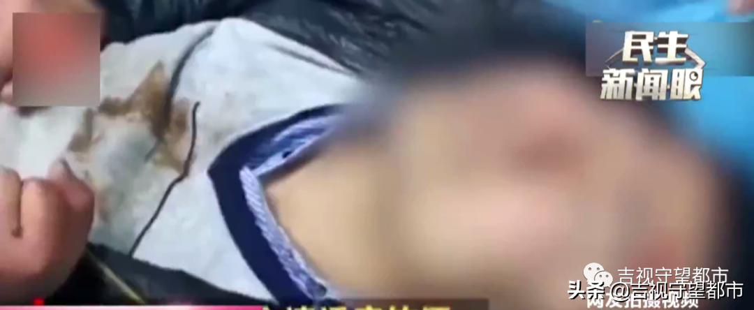 大连一男子聚餐后醉酒冻僵截肢了,男子醉酒躺路边冻僵