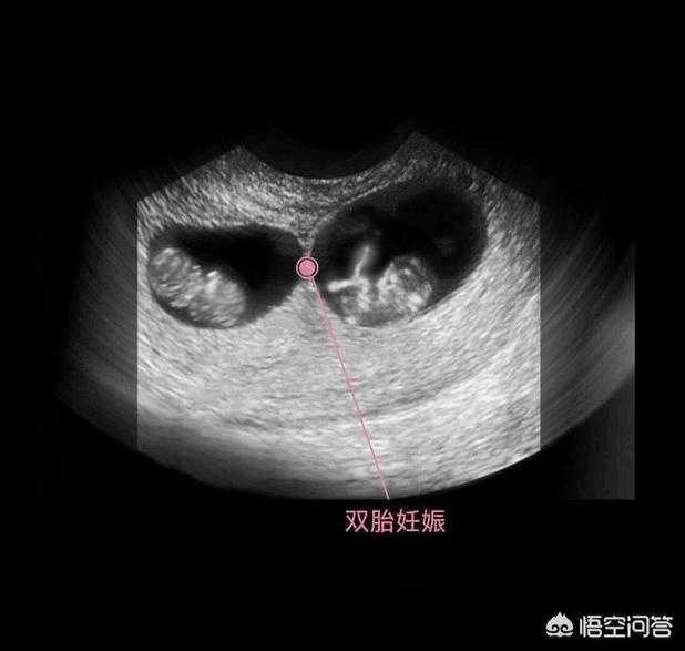 孕妇怀有双胞胎结果只有一个,孕妇怀双胞胎的反应