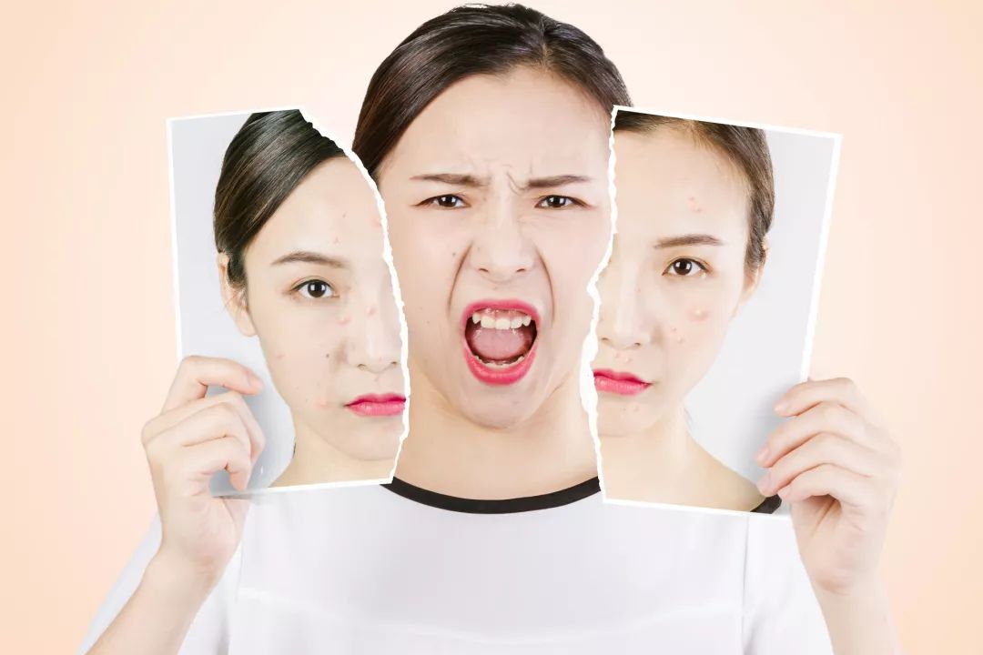 祛除粉刺闭口痘印的方法真实有效,祛除痘印闭口推荐什么产品