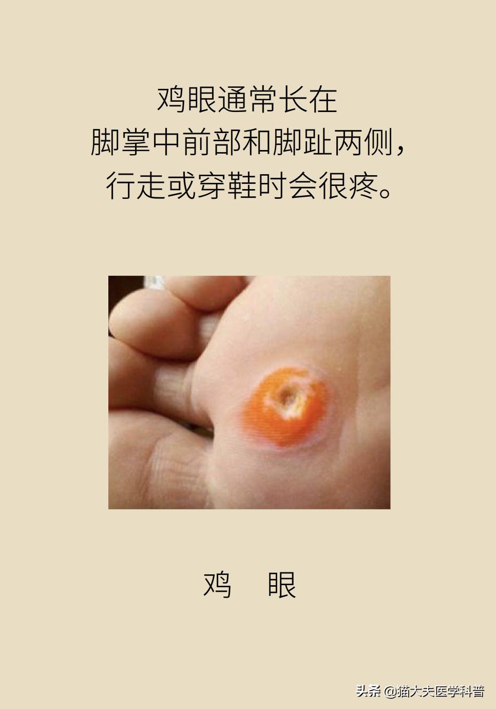 鸡眼好了长了一层老茧,鸡眼与老茧的区别图片