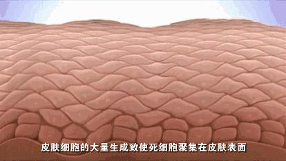 祛背部痘印的日常方法,用什么可以祛后背痘印