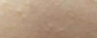 反复长闭口红痘痘怎样调理,满脸闭口痘痘怎么调理