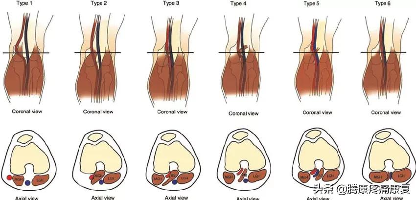 小腿膝关节疼痛是什么原因,小腿窝疼痛是什么原因导致的