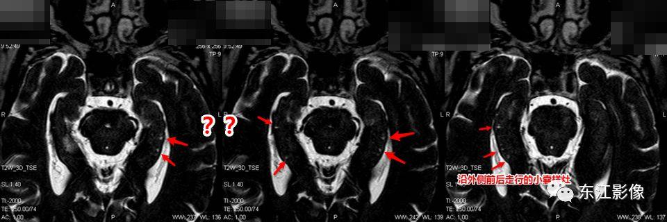 头颅mri扫描影像哪里找,头颅影像mra详细解说