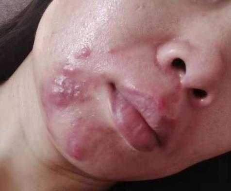 各种痘痘的形成应该如何快速根治,痘痘是怎么形成的原因及解决方法