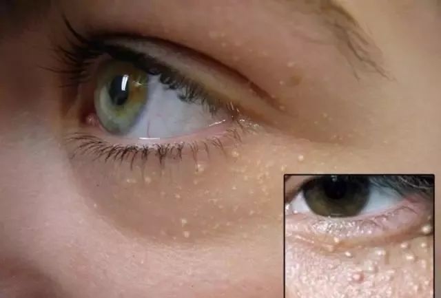 脂肪粒长在眼周围你应该这样做,眼睛周围的脂肪粒怎么快速消除