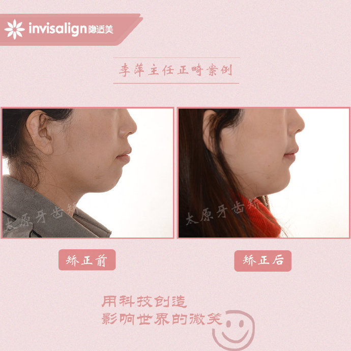 二甲医院骨性前突龅牙矫正多少钱,太原骨性嘴凸矫正牙齿图片