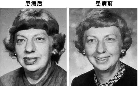 脑垂体病变的面相图解,脑垂体腺瘤面相图片