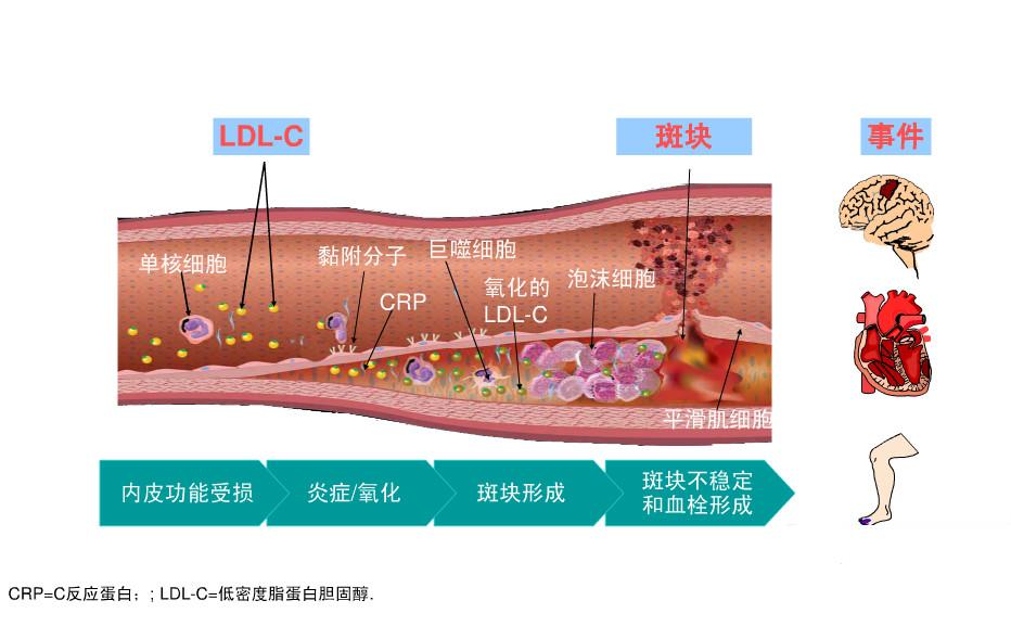 动脉粥样硬化斑块吃哪种他汀最好,他汀类药物对于动脉斑块有作用吗