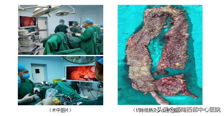 腹腔镜下直肠癌根治术深圳,腹腔镜直肠癌根治术是大手术吗