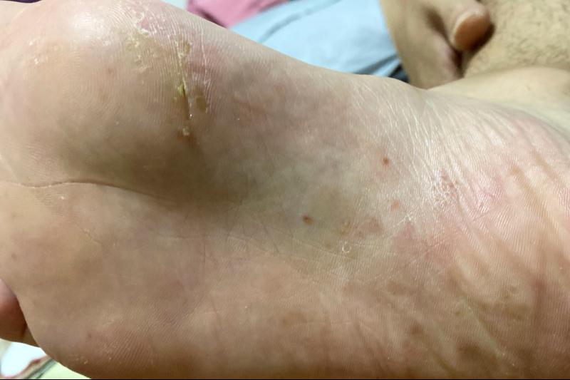 脚上干裂居然是真菌惹的祸