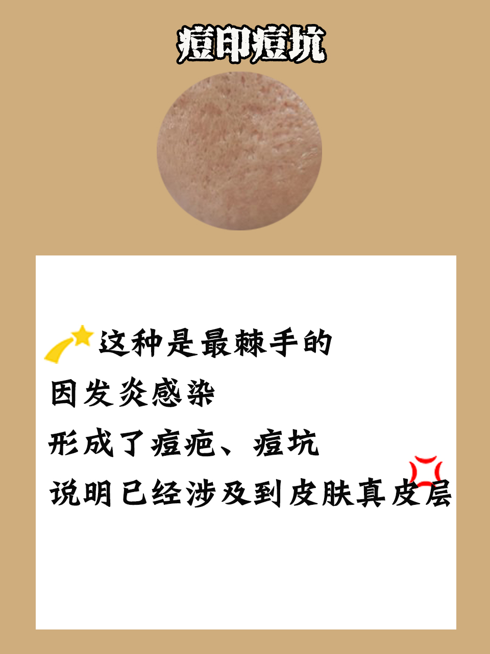 有什么祛痘印方法,简单有效祛痘印方法