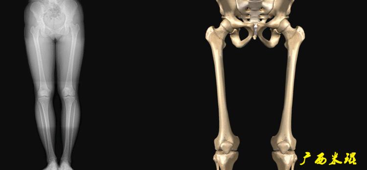 广西骨科医生米琨最新信息,米琨广西骨科什么水平