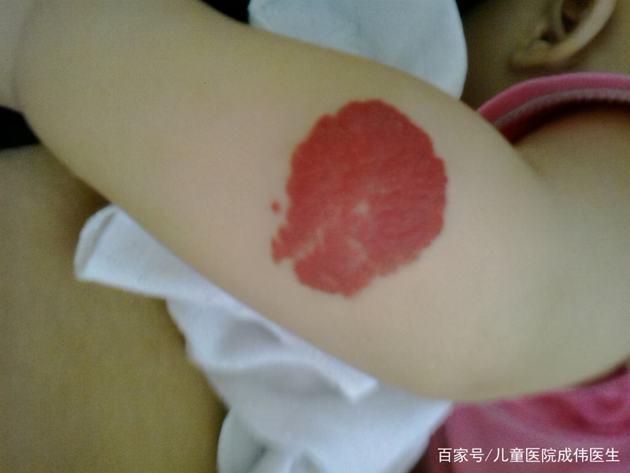 如何辨别宝宝是红胎记还是血管瘤,宝宝身上青一块紫一块图片