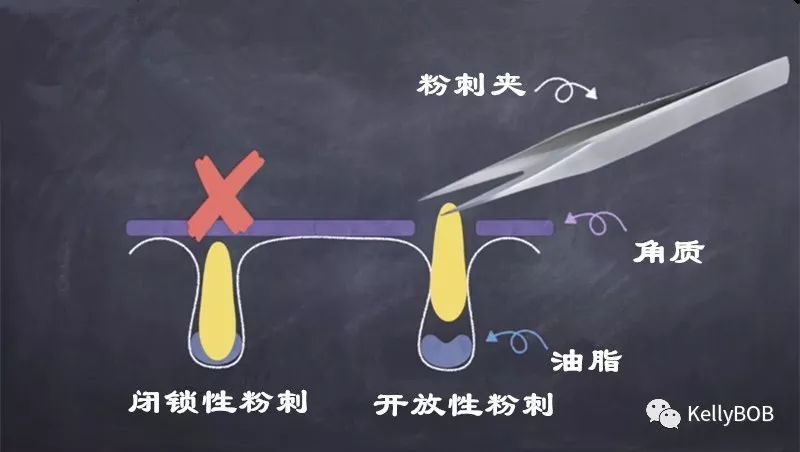 痘痘肌怎么去除粉刺和痘印,如何拯救痘痘肌肤再也不长痘痘